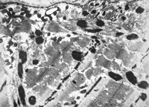 F,56y. | nemaline myopathy v.s. F,56y. | nemaline myopathy v.s.